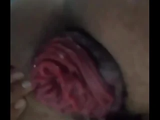 Anal extreme prolapse